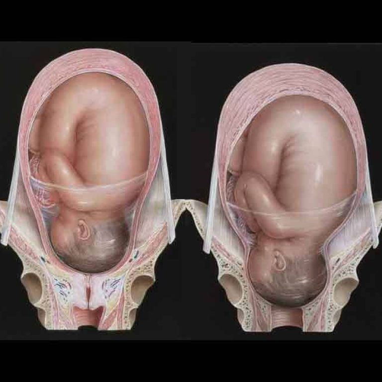 uterus in labour